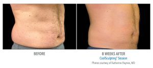 coolsculpting dc