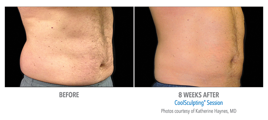 coolsculpting dc