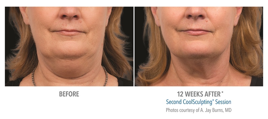 coolsculpting washington dc