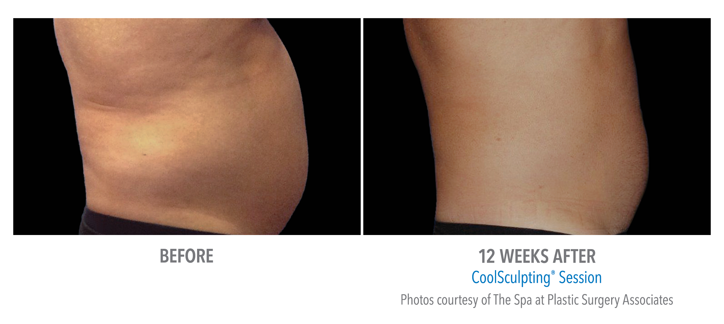 coolsculpting northern virginia
