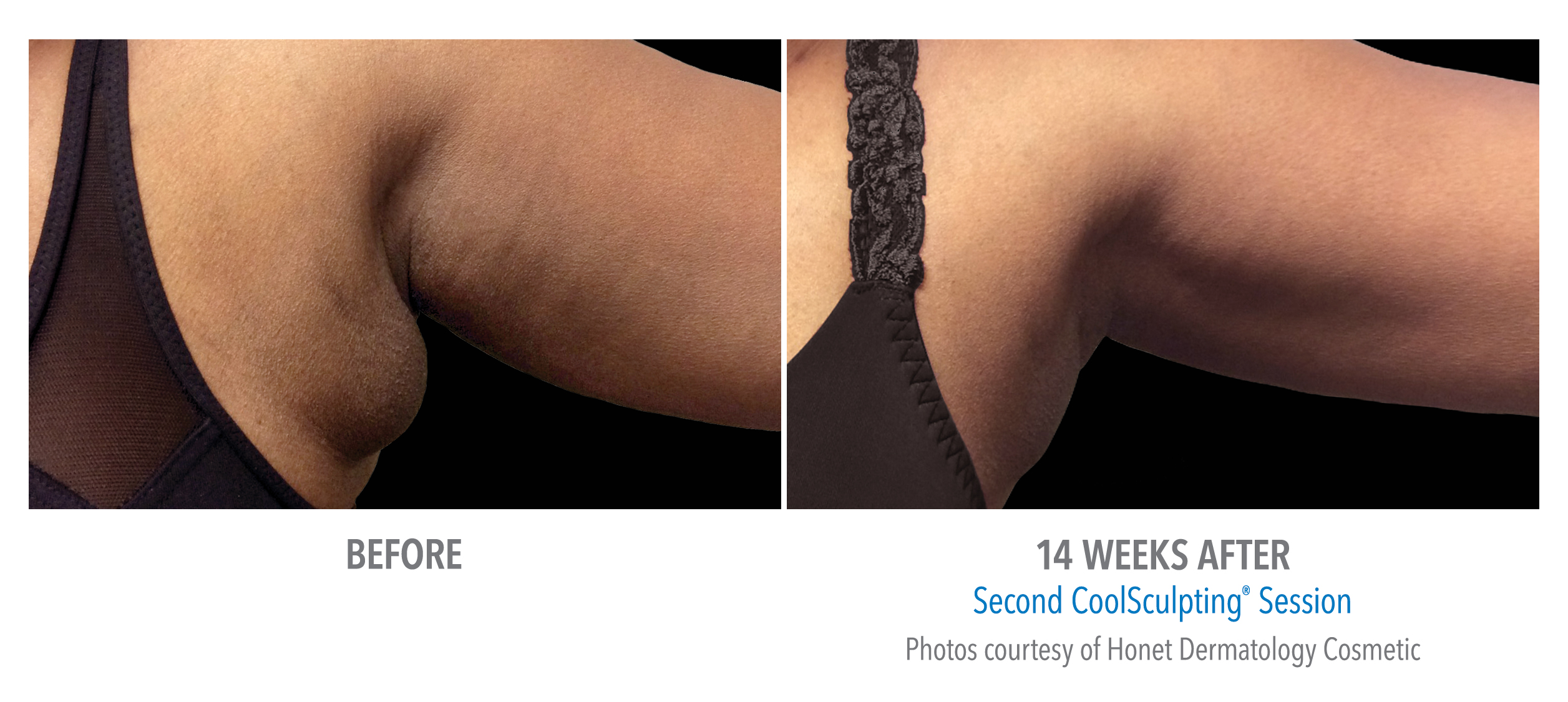 coolsculpting arlington