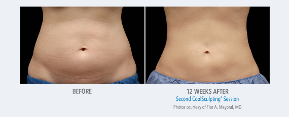 coolsculpting mclean