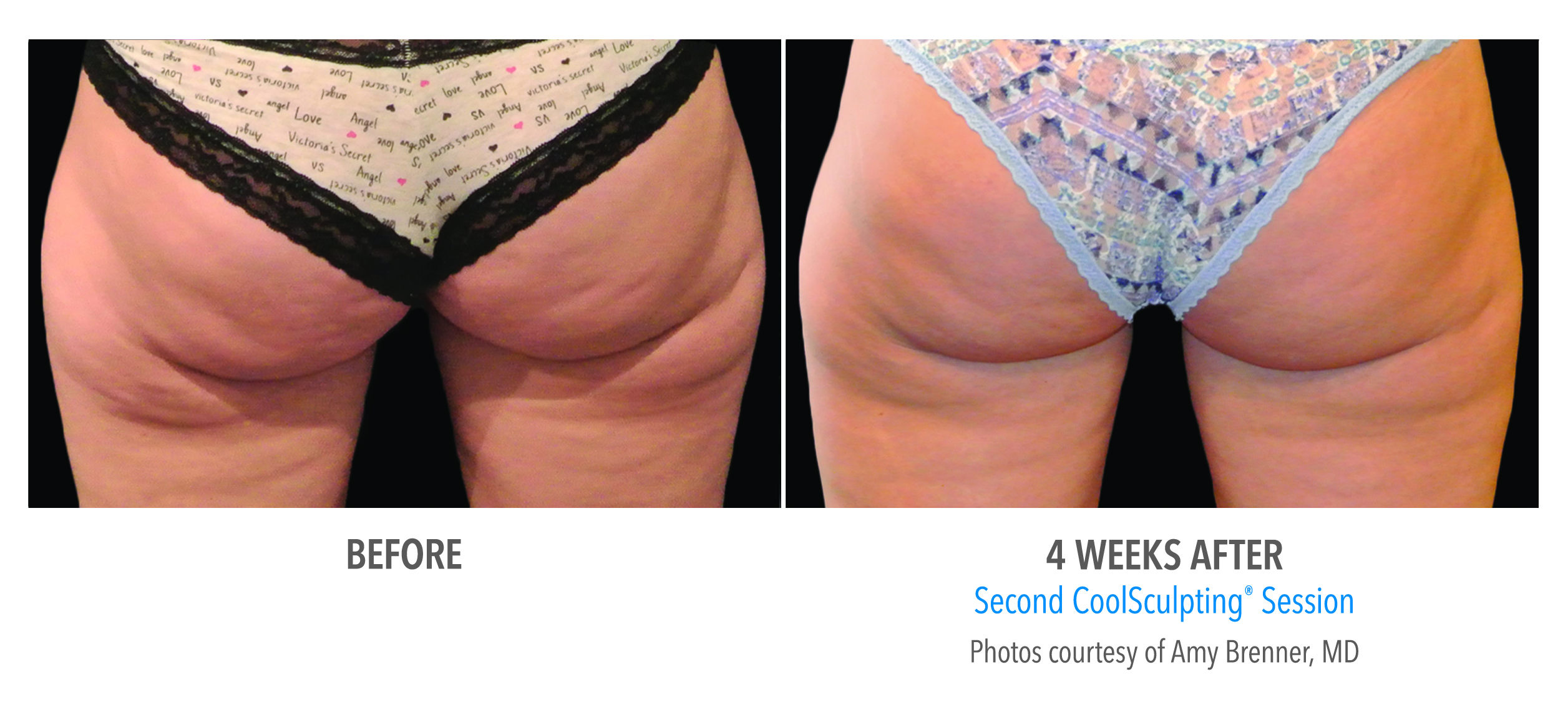 coolsculpting bethesda