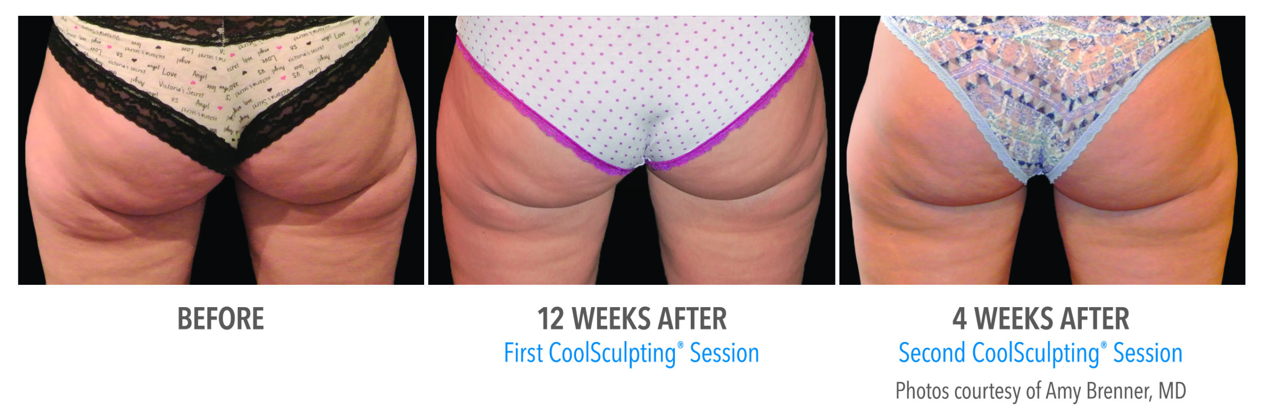 coolsculpting northern virginia