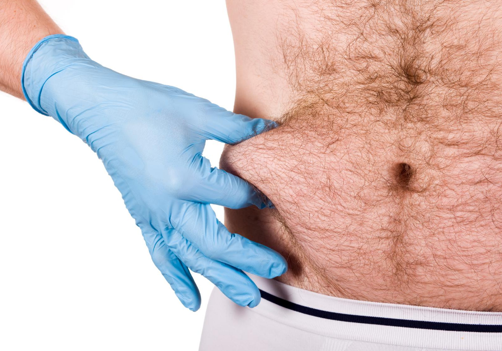 magic of coolsculpting for men