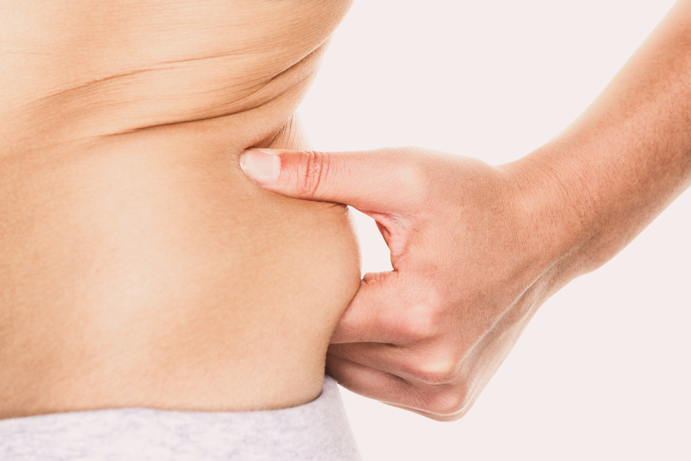 Muffin Top CoolSculpting