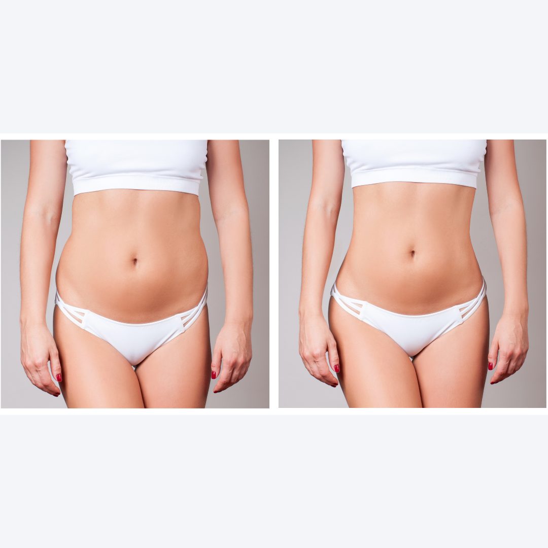 CoolSculpting DC Before and After