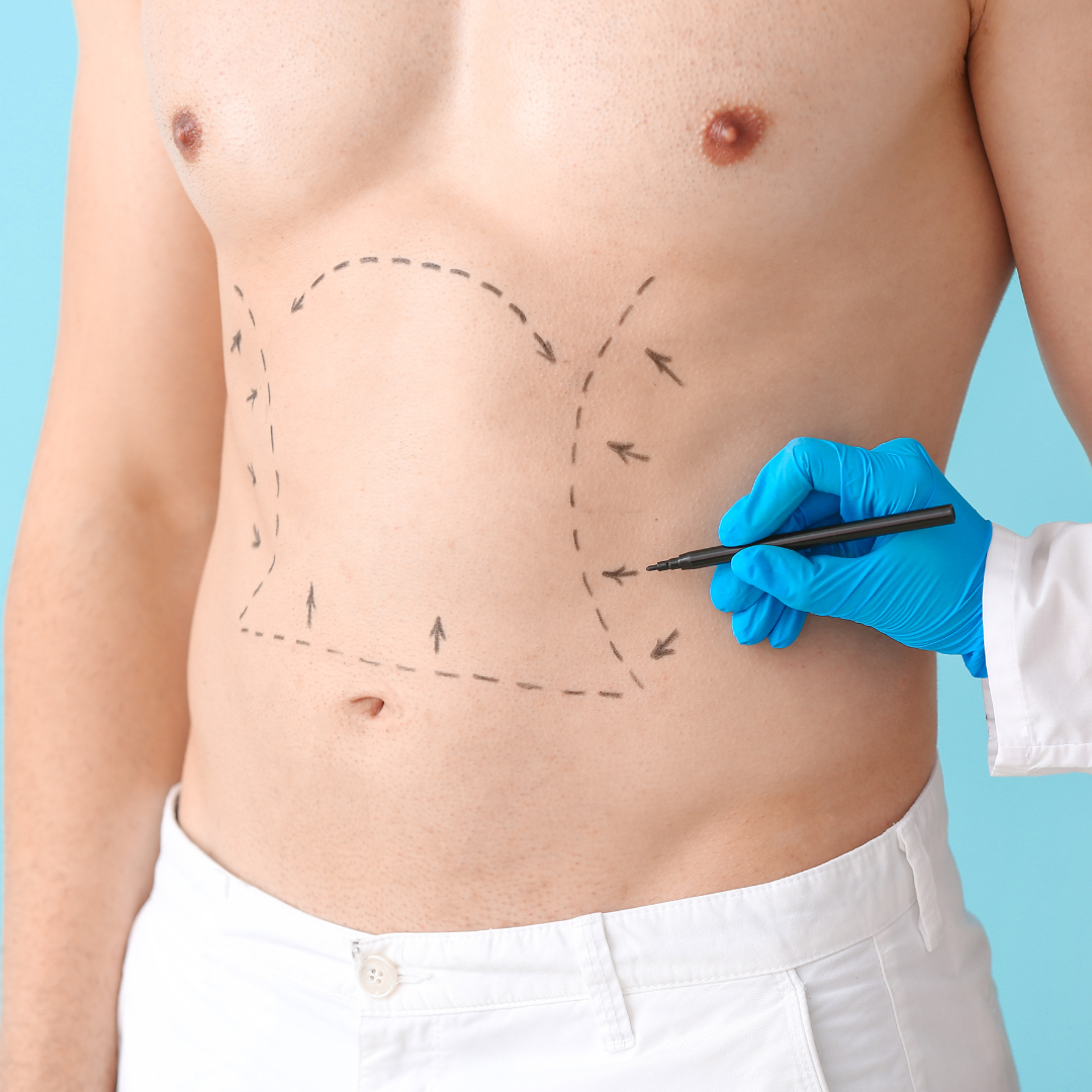 CoolSculpting for Men in DC