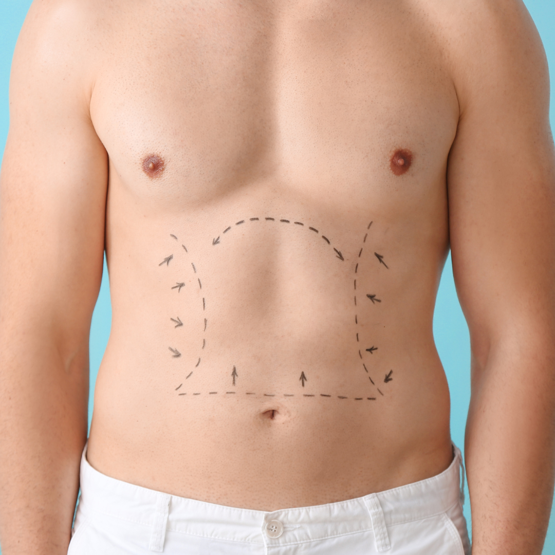 Best CoolSculpting for Men in DC