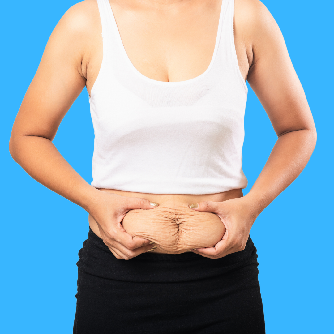 CoolSculpting for the Stomach in DC