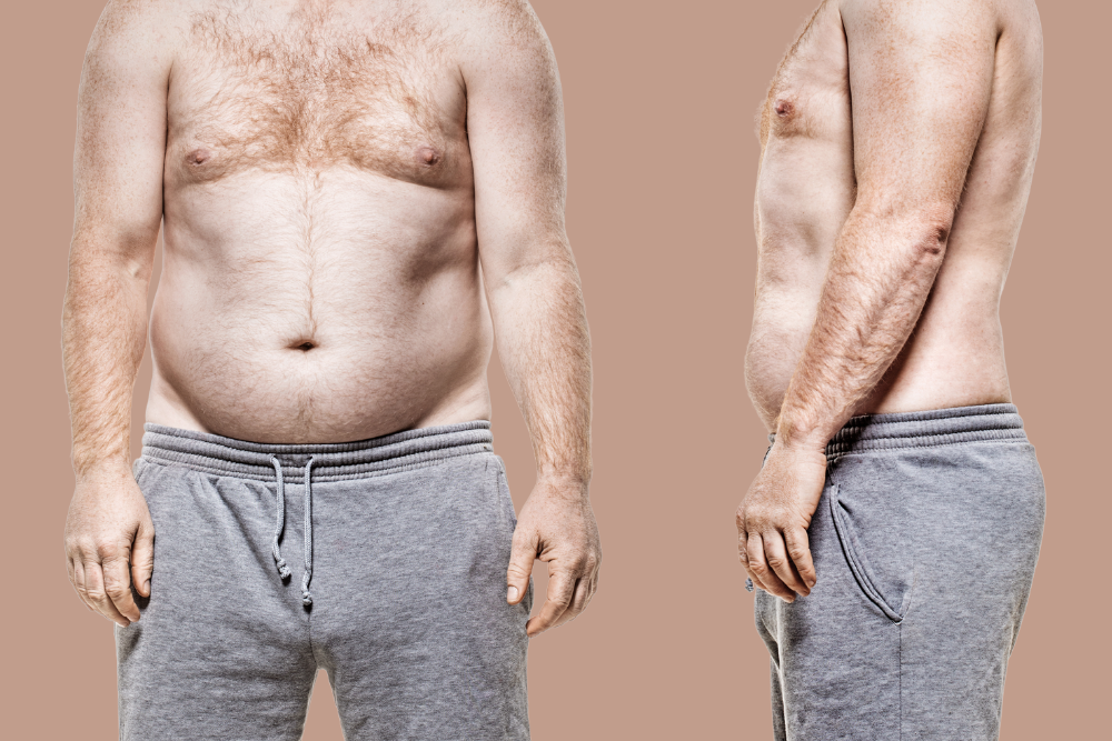 CoolSculpting Before and After Results in West Springfield, VA