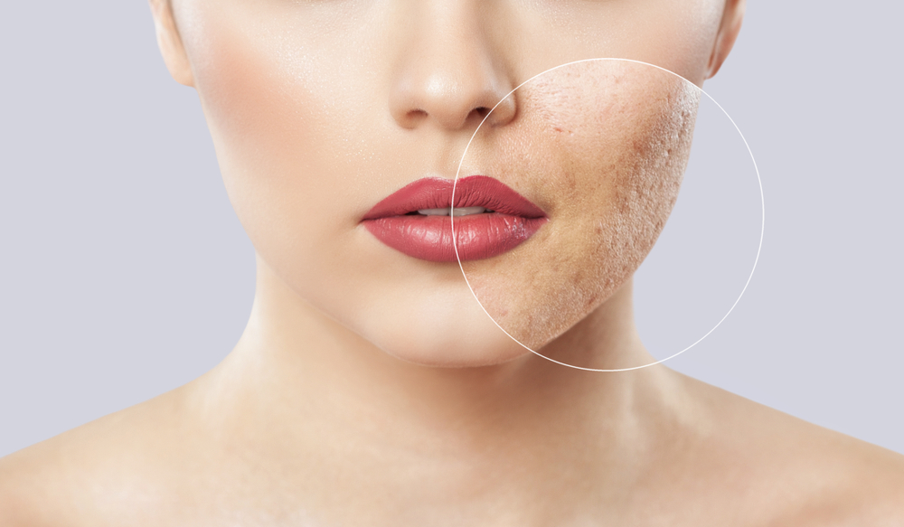 Acne Scar Specialist in Potomac