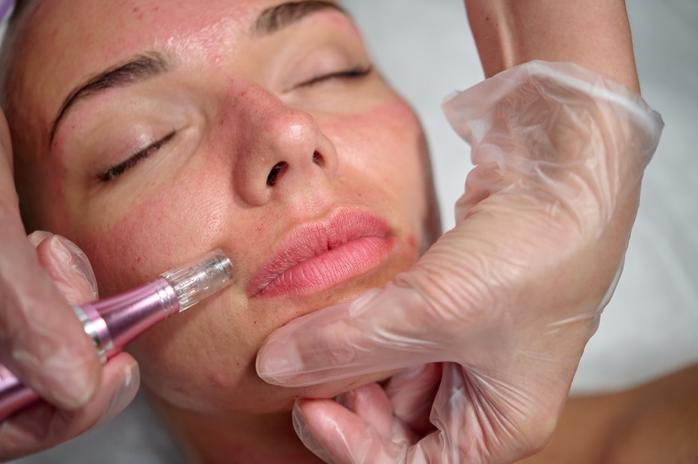 Microneedling Treatments