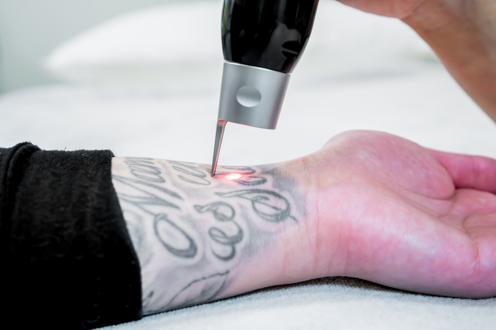 Same-Day Tattoo Removal Near Potomac