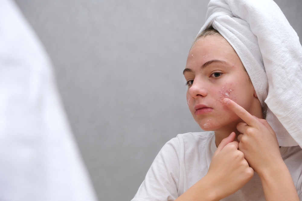 #1 Acne Treatment in Rockville