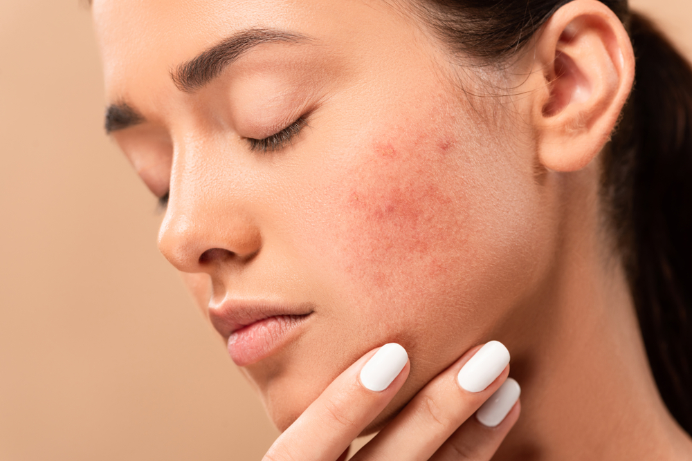 Here's Why AviClear Is the Best Non-Accutane Acne Treatment in Rockville