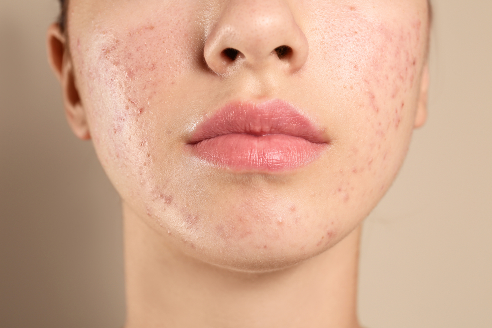 Best Hormonal Acne Treatment Doctor in Bethesda