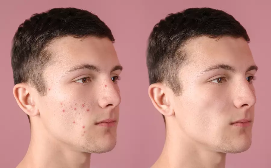 Acne Clinic